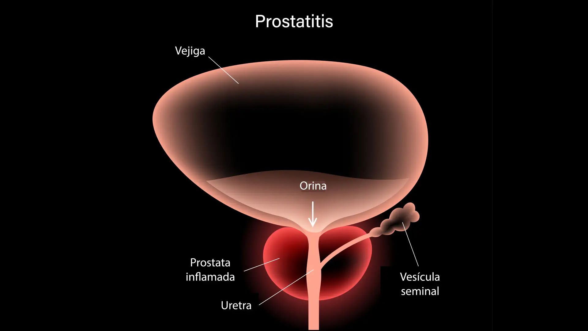 Es la imagen de una prostata con las partes señaladas de la misma, la prostata es de color naranja claro y el fondo es de color negro.